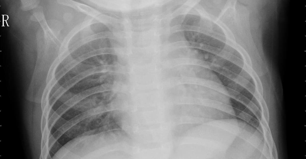 Pneumonia — NIH Chest X-ray14