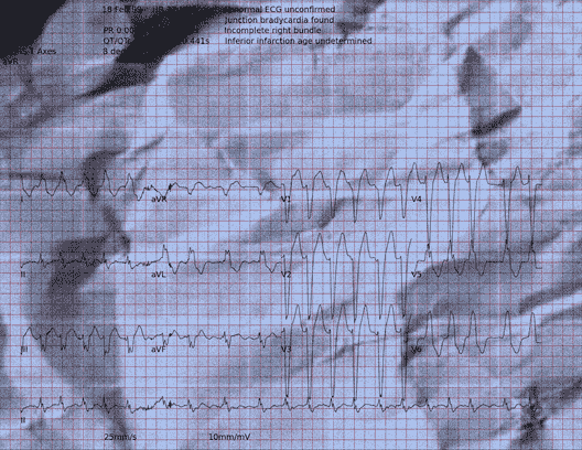 Normal ECG — PTB-XL