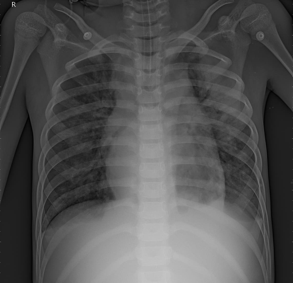 Pneumonia — NIH Chest X-ray14