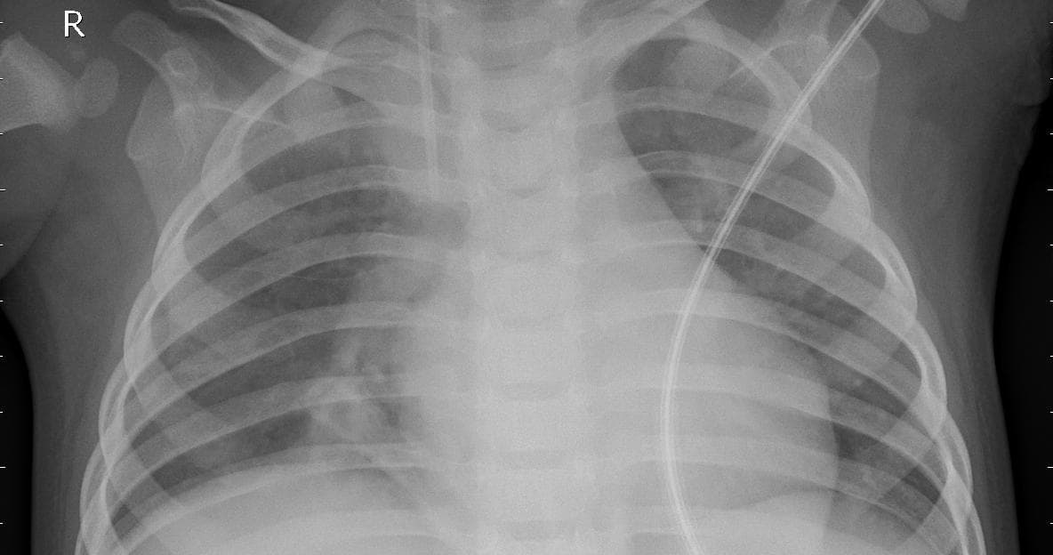 Pneumonia — NIH Chest X-ray14