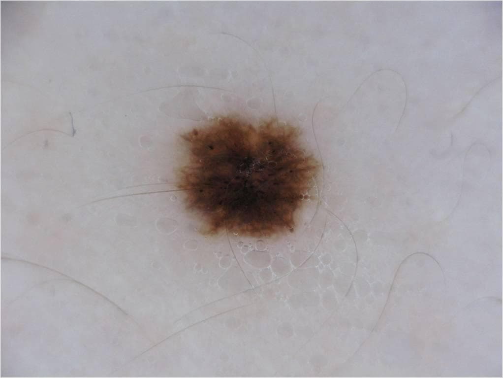 Dermatofibroma — ISIC Archive