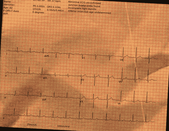 Normal ECG — PTB-XL
