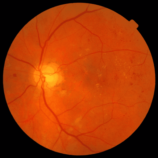 No Diabetic Retinopathy — MESSIDOR-2