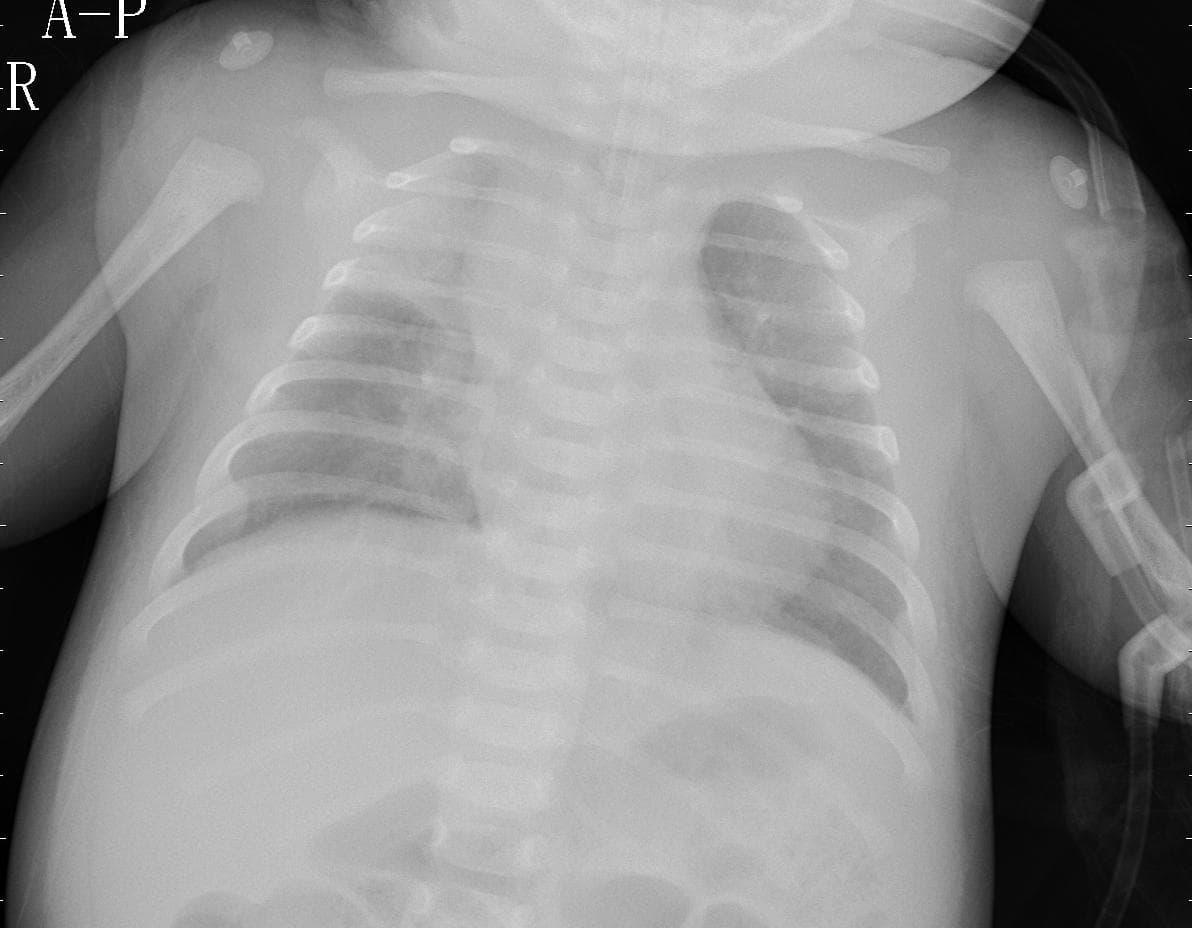 Pneumonia — NIH Chest X-ray14