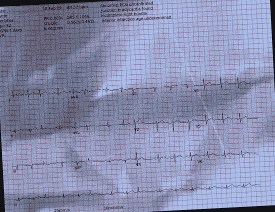 Normal ECG — PTB-XL