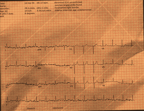 Left Bundle Branch Block — PTB-XL