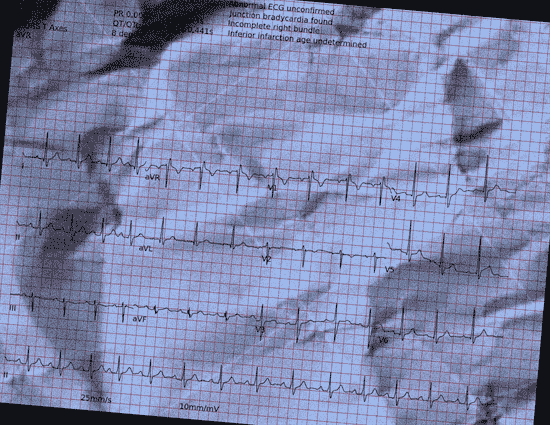Normal ECG — PTB-XL
