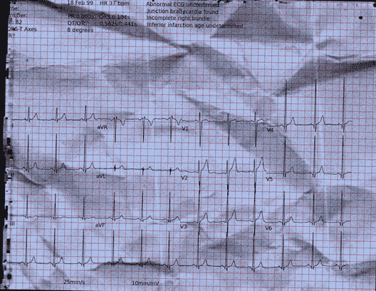 Normal ECG — PTB-XL