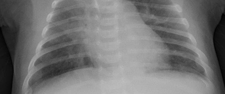 Pneumonia — NIH Chest X-ray14