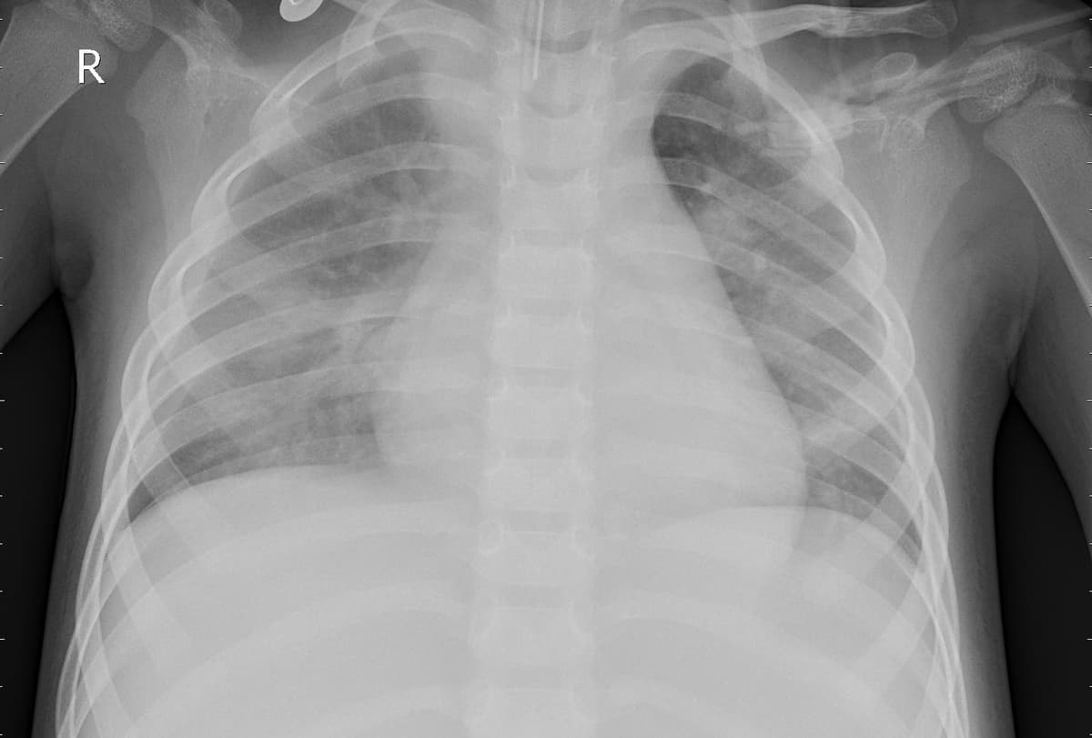 Pneumonia — NIH Chest X-ray14