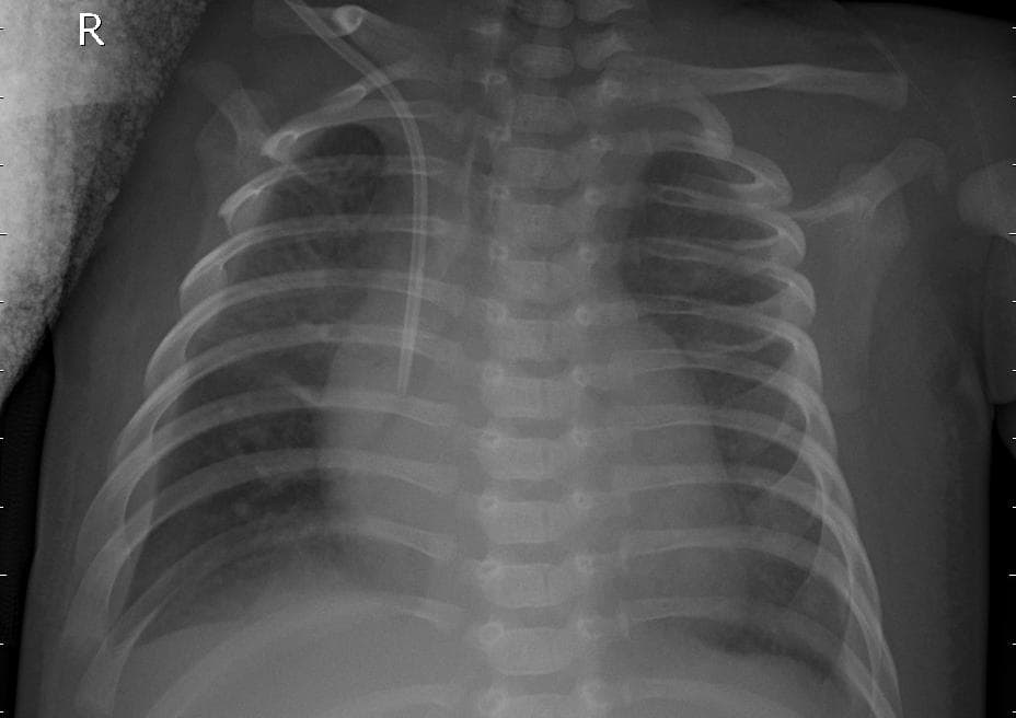 Pneumonia — NIH Chest X-ray14