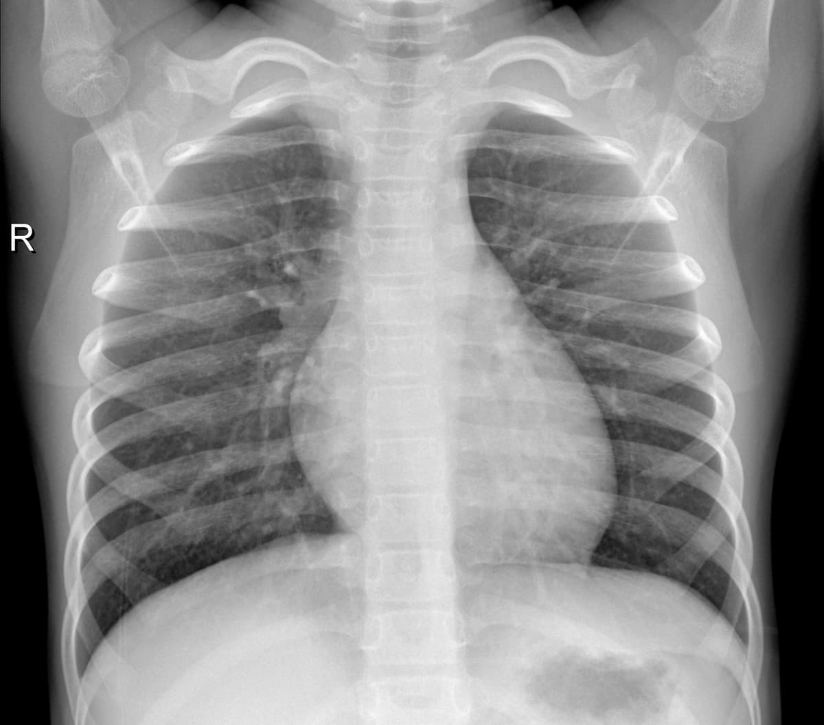 Radiografia Normal — NIH Chest X-ray14