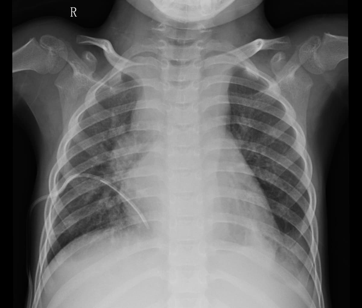 Pneumonia — NIH Chest X-ray14