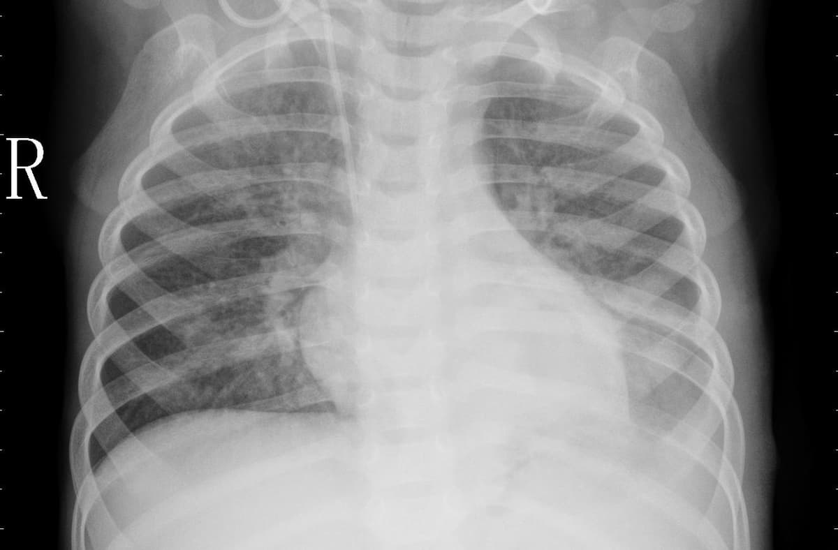 Pneumonia — NIH Chest X-ray14