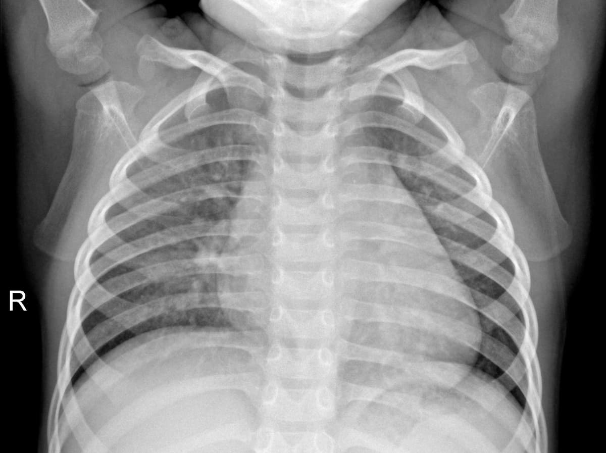Radiografia Normal — NIH Chest X-ray14