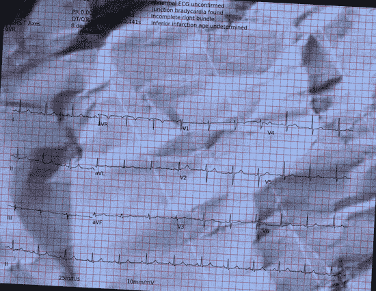 Normal ECG — PTB-XL