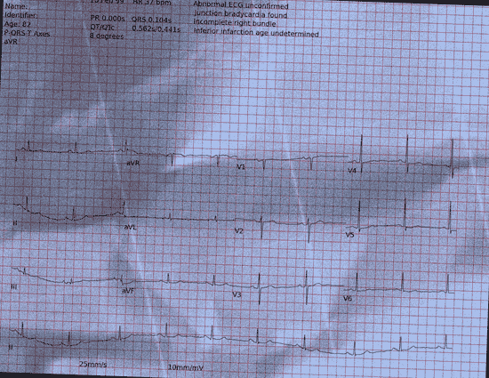 Normal ECG — PTB-XL