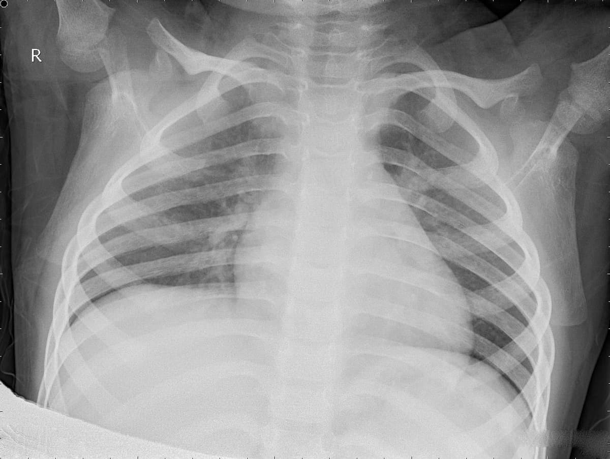 Radiografia Normal — NIH Chest X-ray14