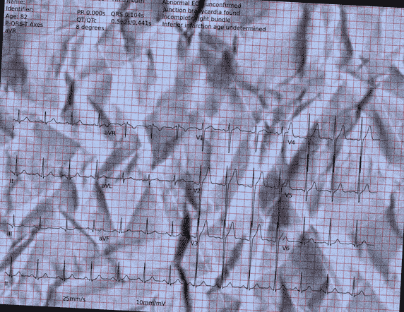 Normal ECG — PTB-XL