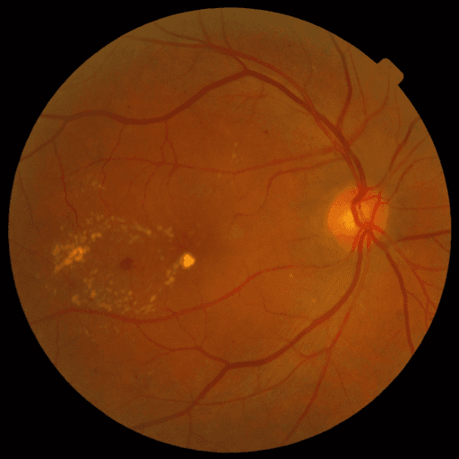 No Diabetic Retinopathy — MESSIDOR-2