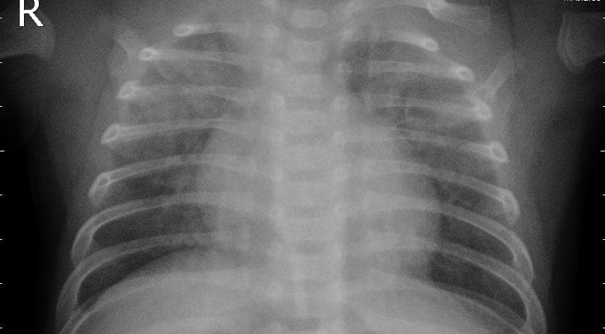 Pneumonia — NIH Chest X-ray14