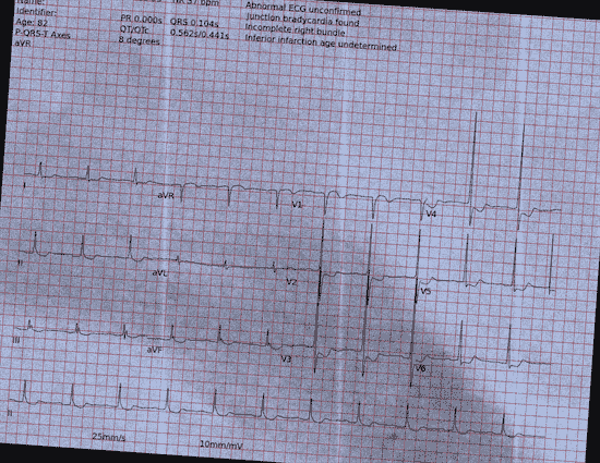 Normal ECG — PTB-XL