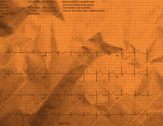 Normal ECG — PTB-XL