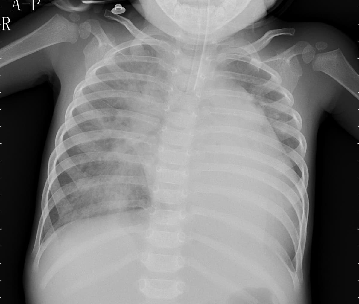 Pneumonia — NIH Chest X-ray14