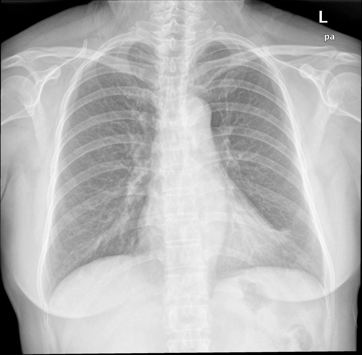 Radiografia Normal — NIH Chest X-ray14