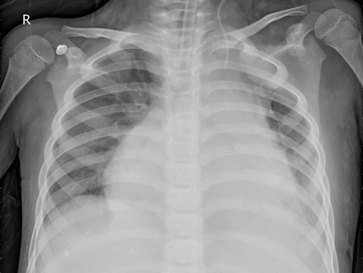 Pneumonia — NIH Chest X-ray14