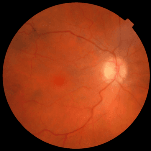 No Diabetic Retinopathy — MESSIDOR-2