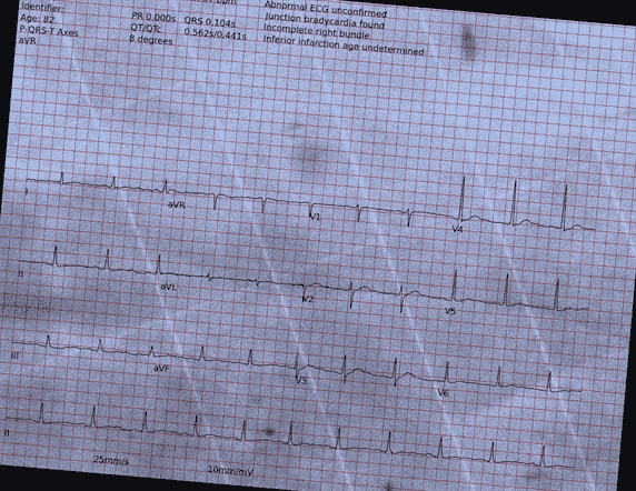 Normal ECG — PTB-XL
