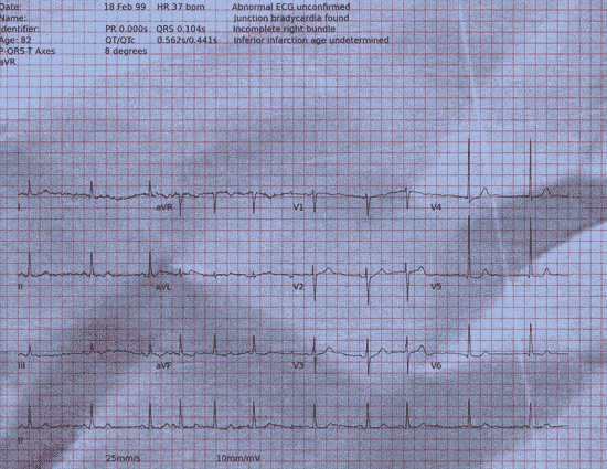 Normal ECG — PTB-XL