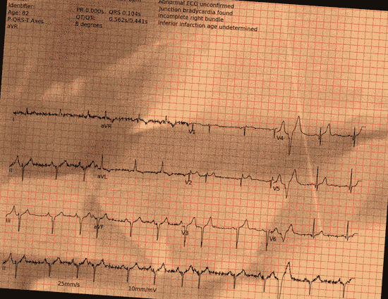 Normal ECG — PTB-XL