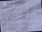Normal ECG — PTB-XL