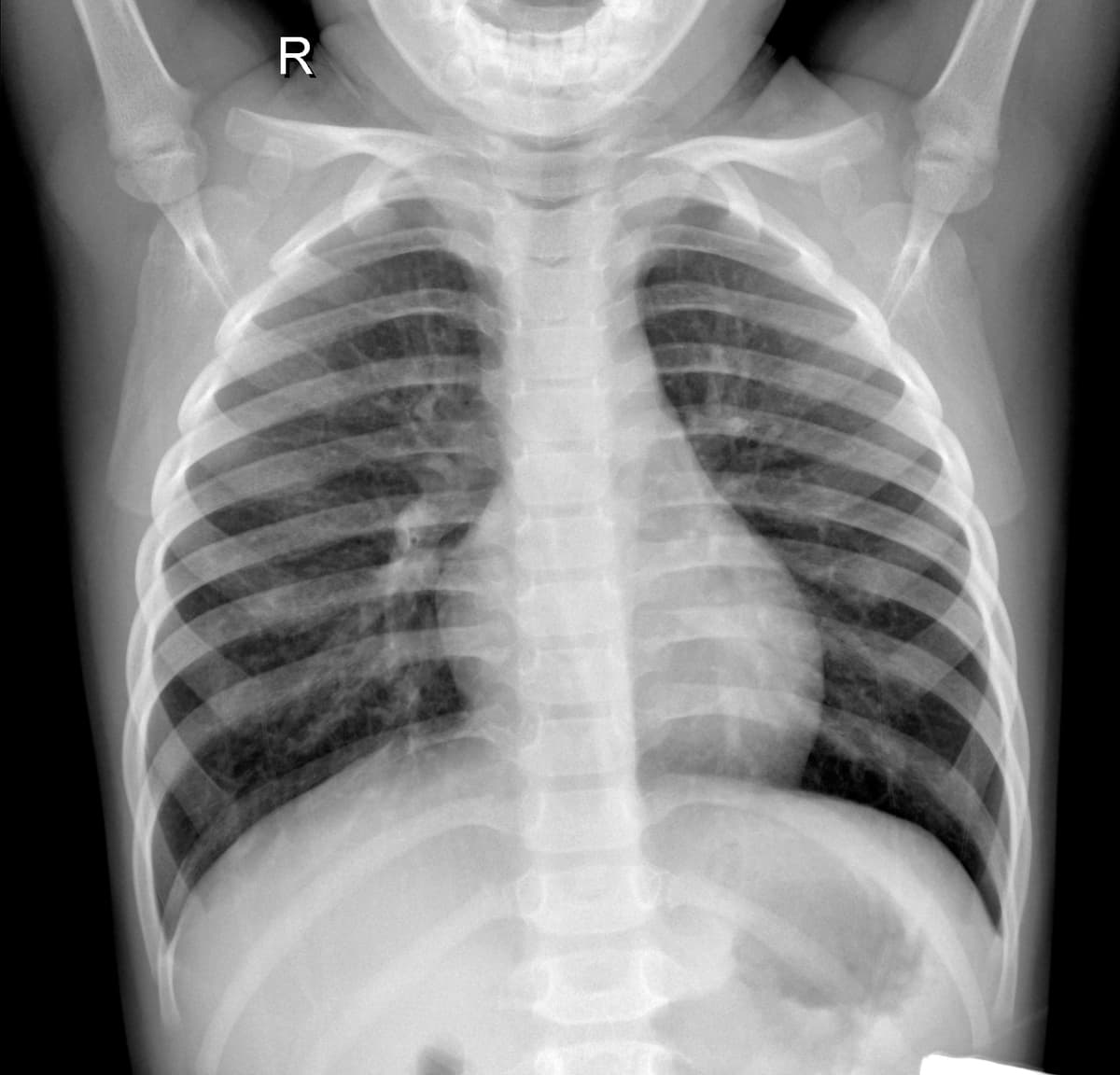 Radiografia Normal — NIH Chest X-ray14