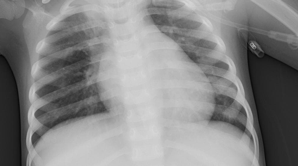 Pneumonia — NIH Chest X-ray14