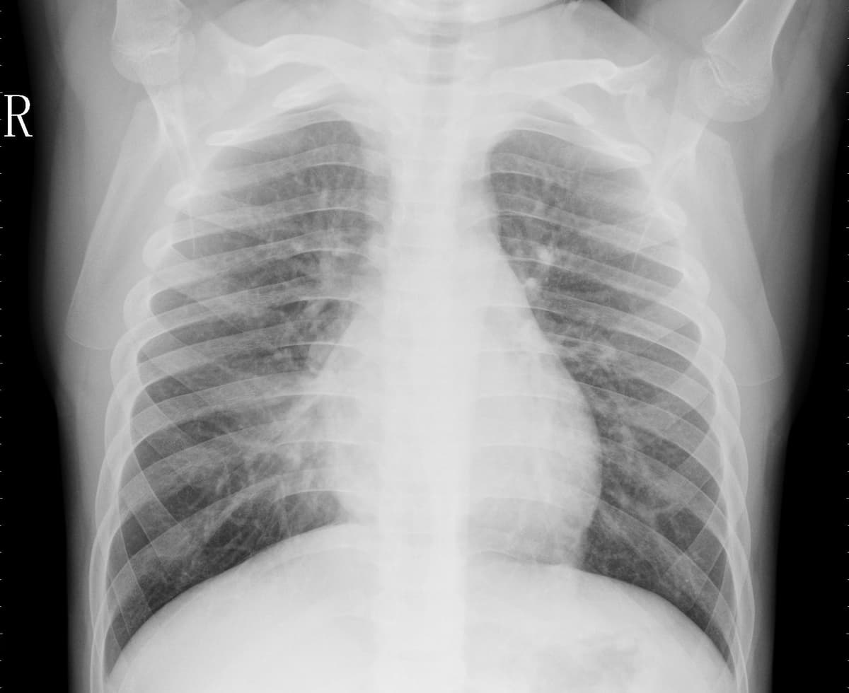 Pneumonia — NIH Chest X-ray14