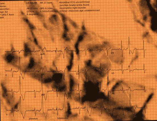 Normal ECG — PTB-XL