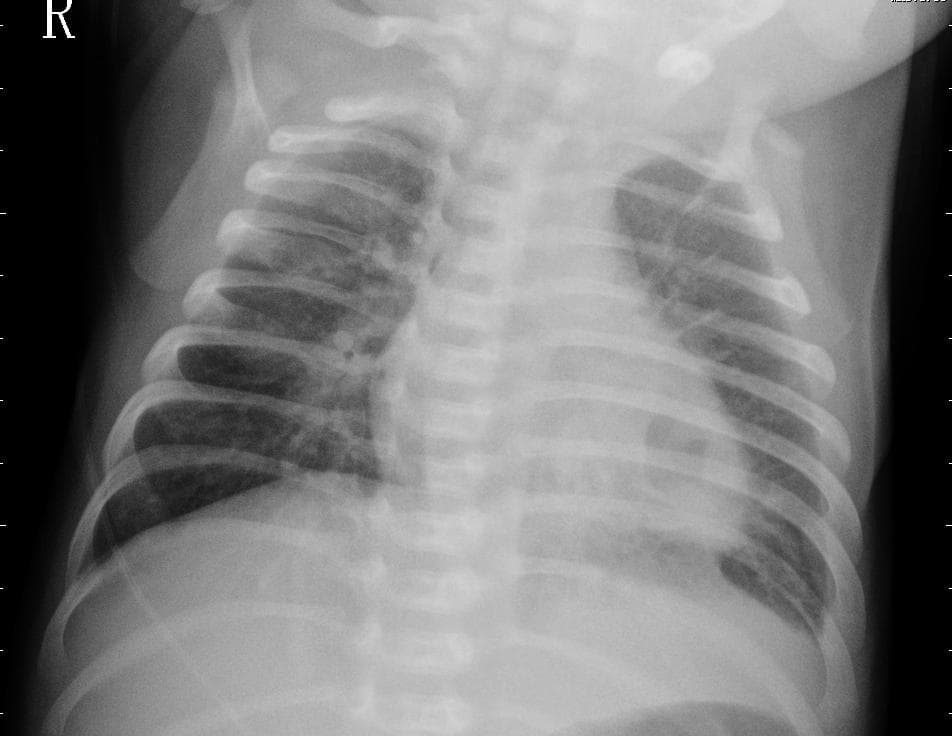 Pneumonia — NIH Chest X-ray14