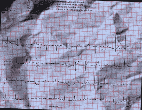 Normal ECG — PTB-XL