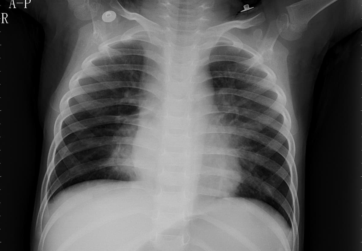 Pneumonia — NIH Chest X-ray14
