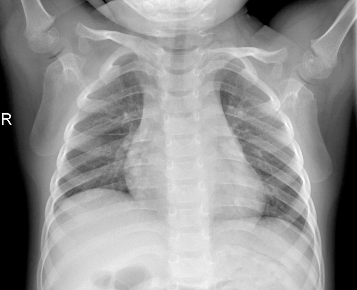 Radiografia Normal — NIH Chest X-ray14