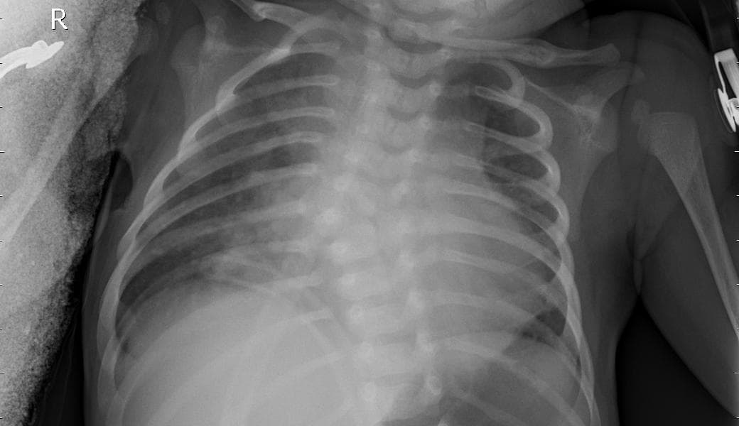 Pneumonia — NIH Chest X-ray14