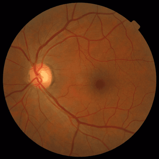 No Diabetic Retinopathy — MESSIDOR-2