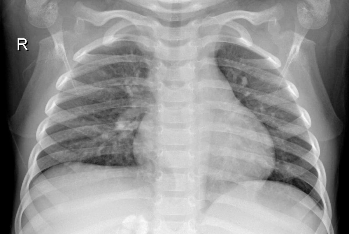 Radiografia Normal — NIH Chest X-ray14