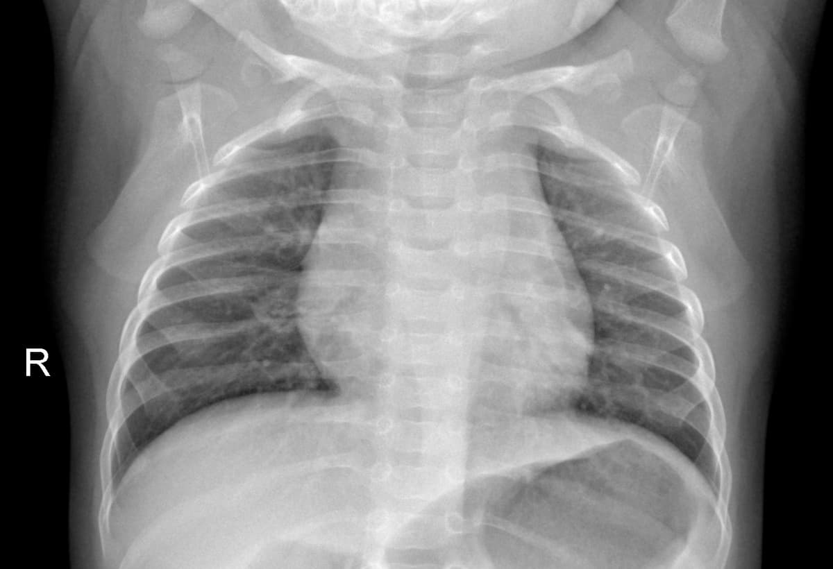 Radiografia Normal — NIH Chest X-ray14