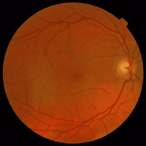 No Diabetic Retinopathy — MESSIDOR-2