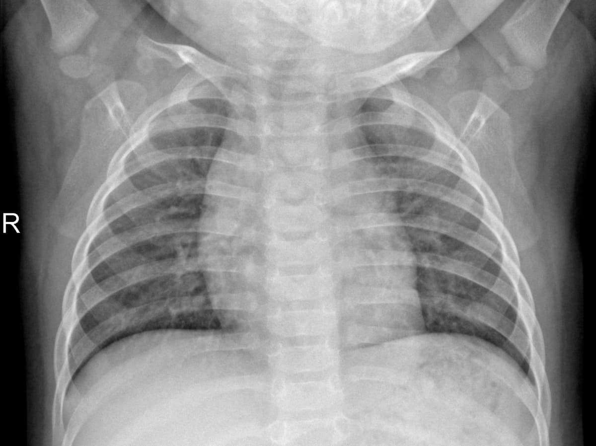 Radiografia Normal — NIH Chest X-ray14