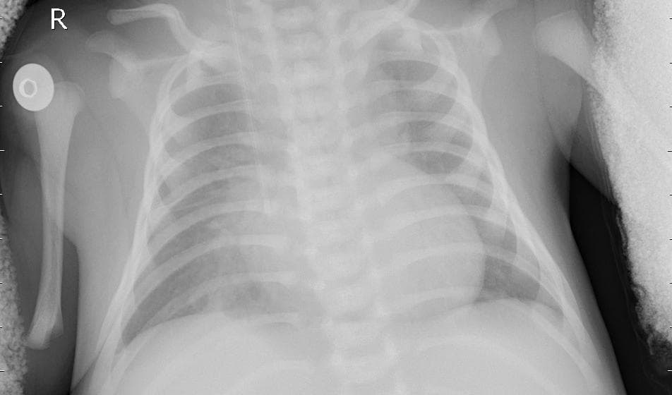 Pneumonia — NIH Chest X-ray14